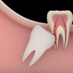 3 things to know before considering dental implants